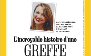 National Geographic documente une greffe totale du visage